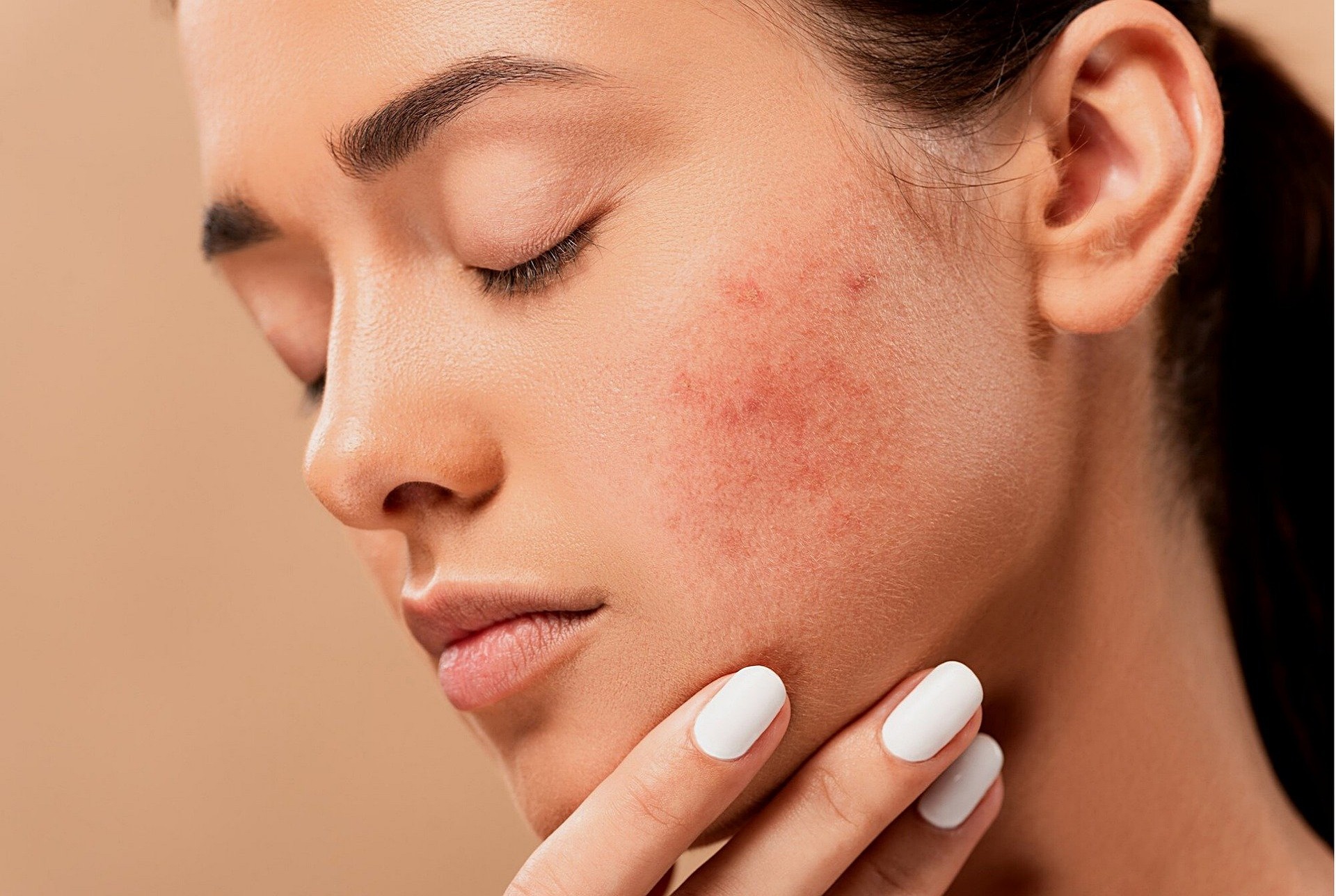 acne-1920 1288